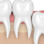 Understanding Tooth Extraction: A Comprehensive Overview